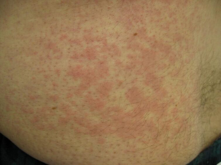 Schistosomes under the human skin cause hives