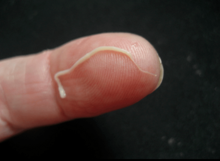 nematode parasite from the human body
